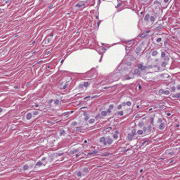 MRP patch3